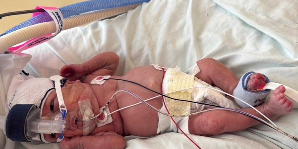 Baby born at 12.5 ounces graduates NICU after 375 days in the hospital